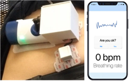 A close-up of the opioid overdose detection wearable prototype device with added sensors  to an existing injector shown on an abdomen and communicated to a smartphone app.