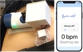 A close-up of the opioid overdose detection wearable prototype device with added sensors to an existing injector shown on an abdomen and communicated to a smartphone app.